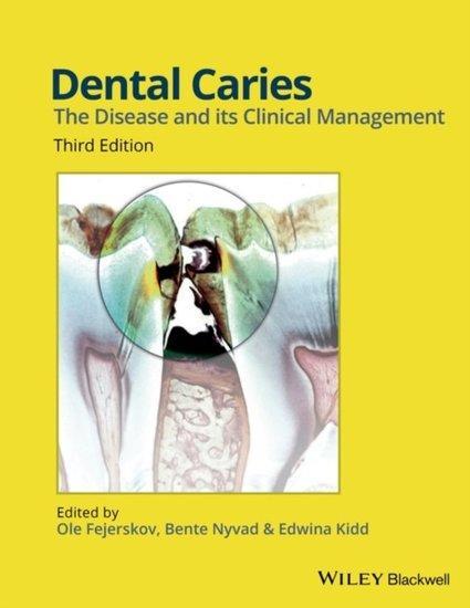 Dental Caries | 9781118935828, Boeken, Studieboeken en Cursussen, Verzenden