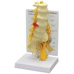Anatomie model lumbale wervelkolom met hernia, Nieuw