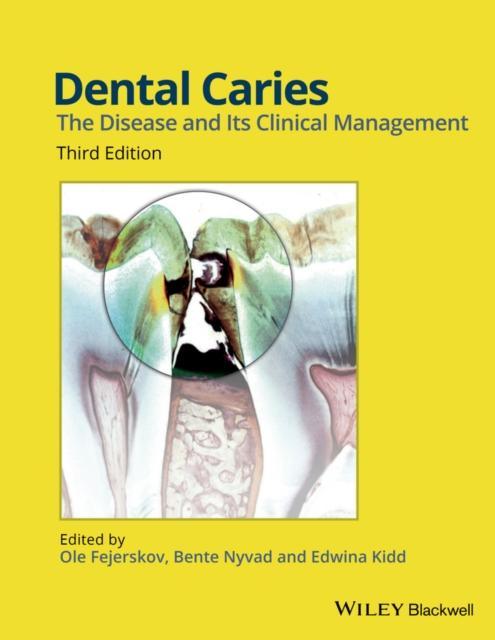 Dental Caries 9781118935828, Boeken, Studieboeken en Cursussen, Zo goed als nieuw, Verzenden