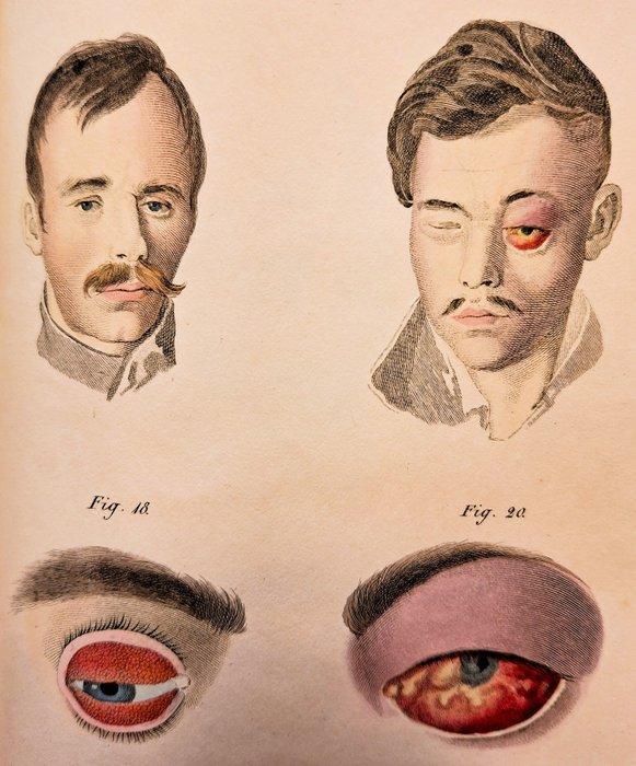 Signé; Florio - Description de lOphthalmie Purulente - 1841, Antiek en Kunst, Antiek | Boeken en Bijbels