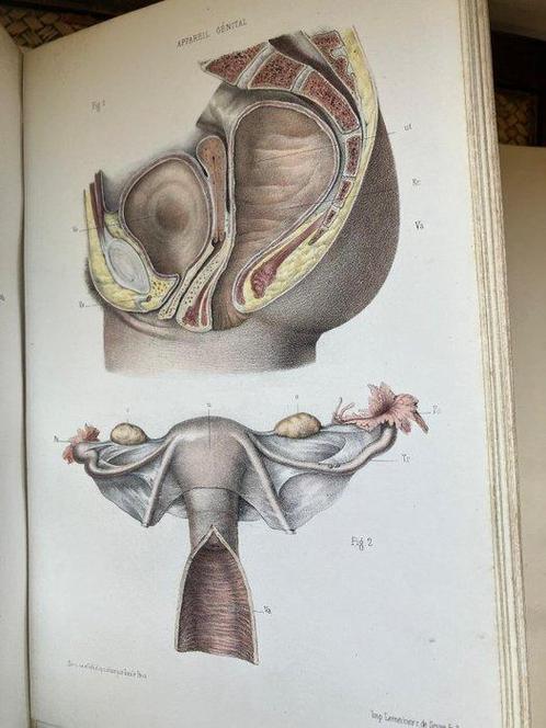 Adolphe Lenoir - Atlas de lart des accouchements - 1881, Antiek en Kunst, Antiek | Boeken en Bijbels