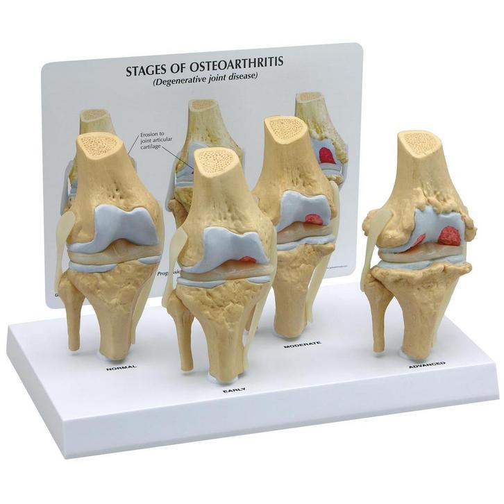 Anatomie model knie met artrose (4 stadia, 8x4x14 cm), Sport en Fitness, Massageproducten